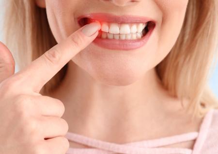 Чем лечить стоматит: проверенные методы и быстрые способы избавления