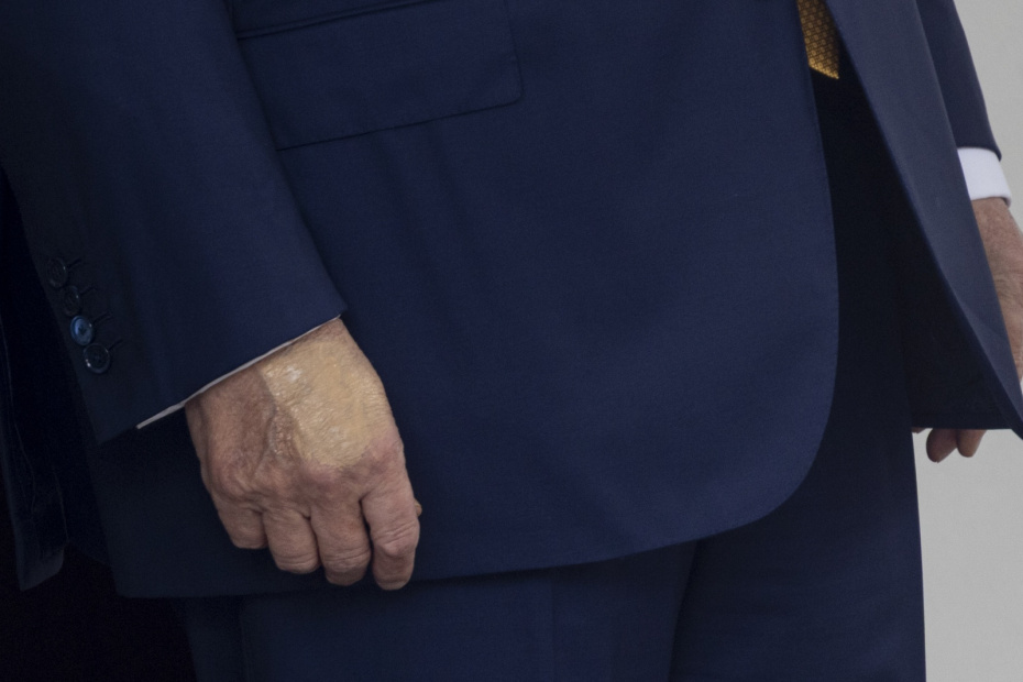 Синяк на руке Дональда Трампа