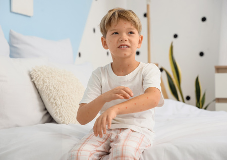 Инфекционист раскрыл смертельную опасность «ветряночных вечеринок»