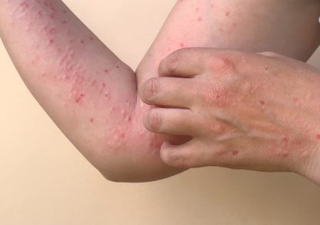 Россиян предупредили о крупной вспышке опасной инфекции на Мальдивах