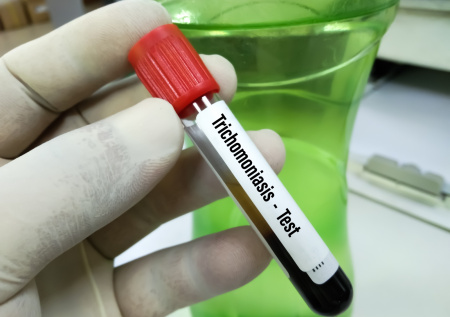 Названо условие полного излечения трихомониаза