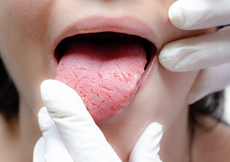 Раскрыто, как можно определить рак по языку