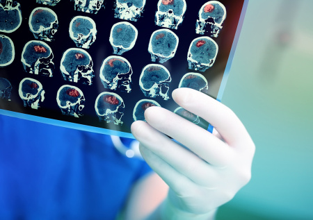 Девушка без мозга шокировала медиков и поставила рекорд