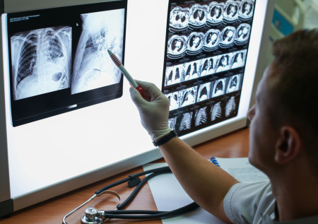 Онколог ответила, влияет ли COVID-19 на развитие рака легких