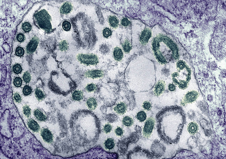 В Эфиопии заявили о вспышке смертельно опасной лихорадки