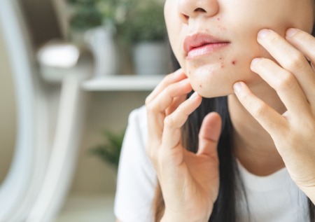 Россиянам дали советы, как эффективно избавиться от прыщей