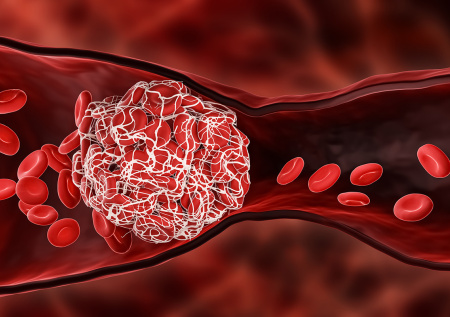 «Главный диверсант»: россиянам назвали основные причины тромбоза