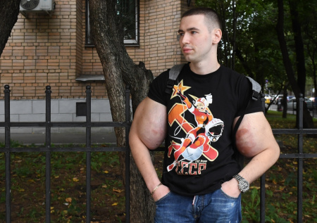 «Базуки» ампутируют? Известный блогер может остаться без рук: что известно