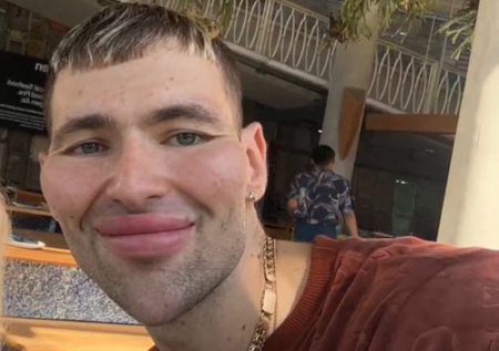 Хирург раскрыл, можно ли спасти «руки-базуки» Кирилла Терешина