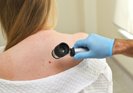 Врач рассказала, как распознать опасную родинку