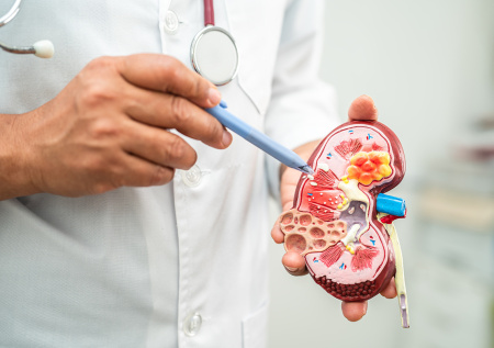 Уролог назвал неочевидные продукты, которые приводят к камням в почках