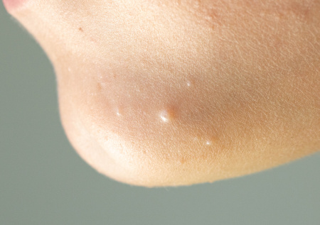 Спасаемся от контагиозного моллюска: симптомы, как не заболеть, лечится ли