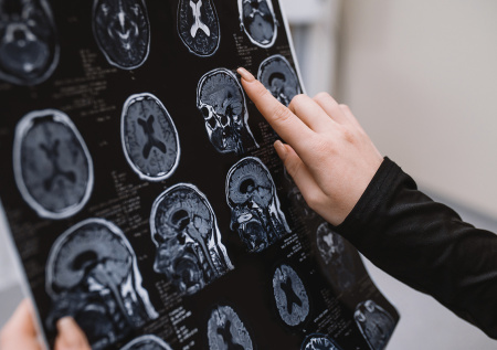 Невролог назвала неочевидный признак повышенного риска болезни Альцгеймера