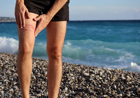 Россияне покрылись кнутовыми полосами и волдырями после купания на Пхукете