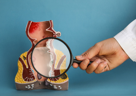 Россиянам раскрыли, что вызывает геморрой