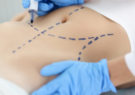 Хирург предупредил о смертельной опасности липосакции