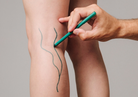 Хирург объяснил, в чем главная опасность тромбоза