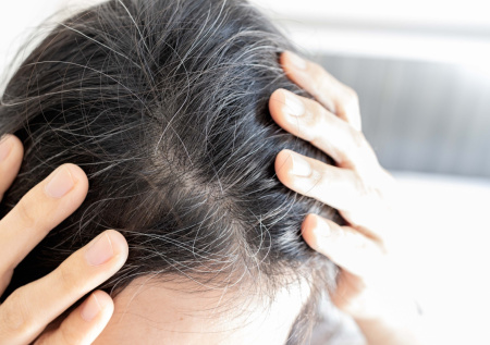 Трихолог назвала неочевидную причину потери волос