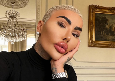 «Король губ» скончался после неудачной бьюти-процедуры