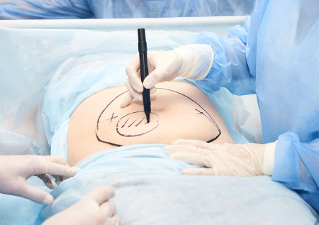 Хирург рассказала, может ли липосакция избавить от целлюлита