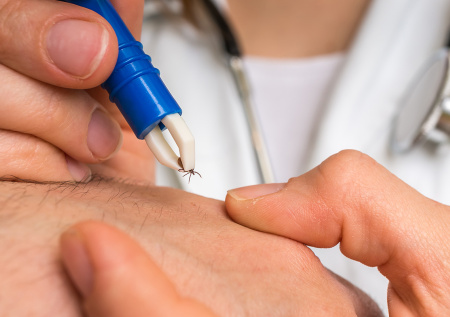 Врач рассказала, что делать при укусе клеща