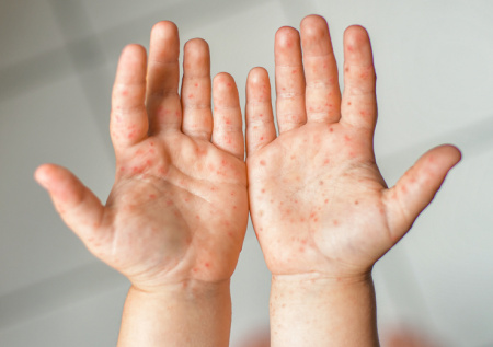 Школьник из Петербурга заболел корью