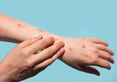 В Роспотребнадзоре оценили риски завоза оспы обезьян в Россию