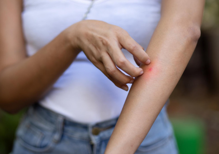 Россиянка на Бали получила ожогоподобную сыпь из-за гусеницы