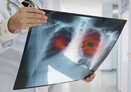 Названы ежедневные привычки, повышающие риск рака