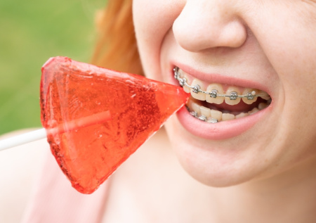 Ортодонт назвал главную опасность преждевременного снятия брекетов