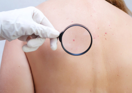 Ребенку потребовалась пересадка кожи после удаления родинки