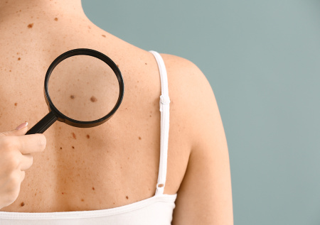 Опасные родинки: как распознать меланому до появления симптомов