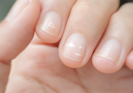 Врач рассказала, о каких проблемах говорят белые точки на ногтях