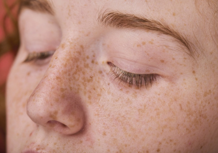 Дерматолог ответила, могут ли веснушки спровоцировать развитие рака