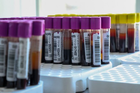 Врач назвала два вещества в крови человека, способных разрушить почки