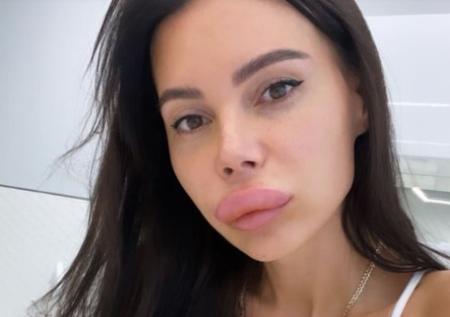 Жена Джигана напугала поклонников невероятно опухшими губами