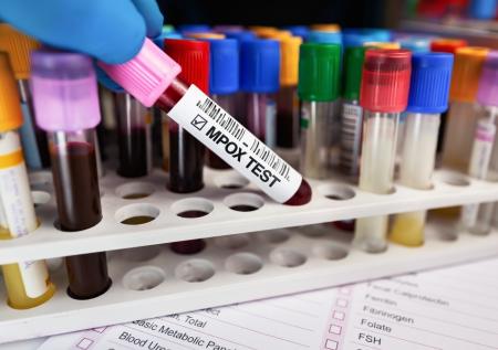 Житель ЮАР скончался от редкого заболевания mpox