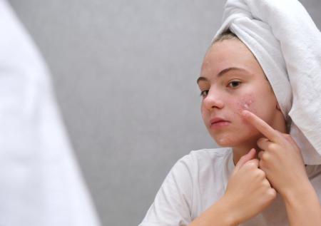 Названы неожиданные причины появления акне