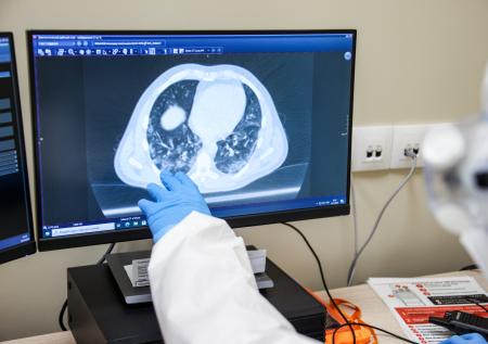 Нейросеть научили определять риск развития рака лёгких